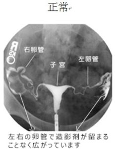 痛い？痛くない？子宮卵管造影検査 | スタッフブログ | 桂川レディースクリニック - 滋賀県大津市